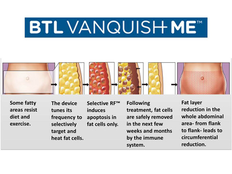 btl-vanquish-me-graph